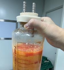 高唐水动力吸脂手术要做多久？